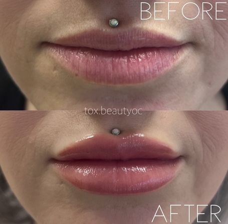 Close-up before-and-after lip augmentation: top shows natural lips with a small upper-lip piercing, bottom shows fuller, plumper, glossy lips after filler — cosmetic lip enhancement result.
