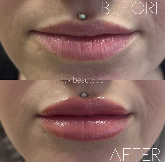 Close-up before-and-after lip augmentation: top shows natural lips with a small upper-lip piercing, bottom shows fuller, plumper, glossy lips after filler — cosmetic lip enhancement result.