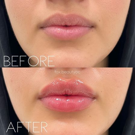 Tox & Glow Med Spa Party for Groups — Concierge Tox and Skin Boosters at Home image 3