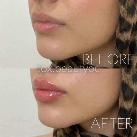 Close-up side-profile before-and-after of lips showing natural matte lips above and fuller glossy lips below after cosmetic lip enhancement