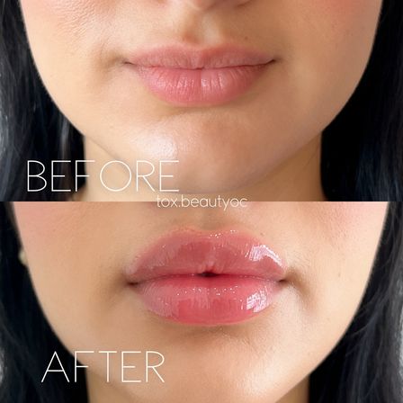 Tox & Glow Med Spa Party for Groups — Concierge Tox and Skin Boosters at Home image 6