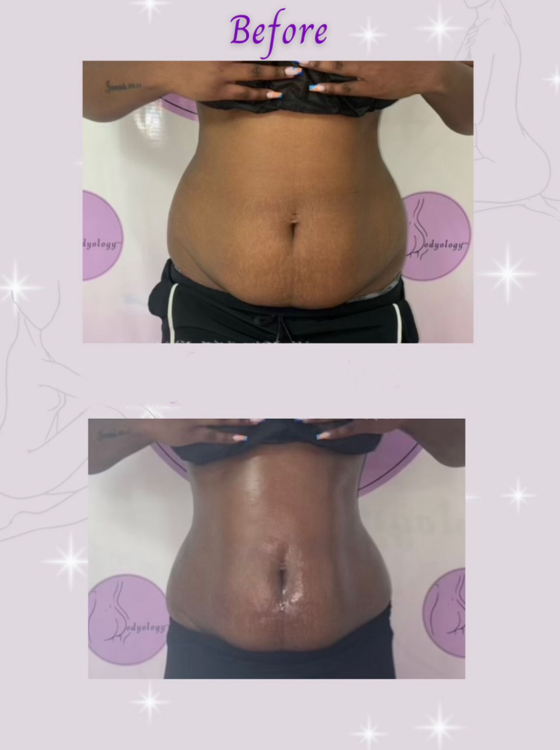 Before-and-after front view of a person’s midsection showing abdominal slimming and a more defined waistline after body contouring treatment.