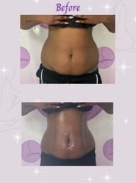 Before-and-after front view of a person’s midsection showing abdominal slimming and a more defined waistline after body contouring treatment.
