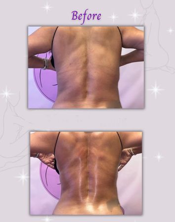 Before: two studio photos of a person’s bare mid and lower back with visible spine and skin texture, arms raised against a lavender backdrop — spa body-contouring treatment preview.