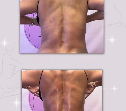 Before: two studio photos of a person’s bare mid and lower back with visible spine and skin texture, arms raised against a lavender backdrop — spa body-contouring treatment preview.