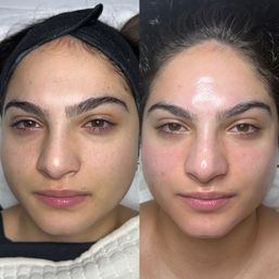 Side-by-side close-up before-and-after of a woman’s face: left shows matte skin with visible pores and under-eye shadows, right shows dewy, slightly red skin after a facial treatment — glowing skincare result.