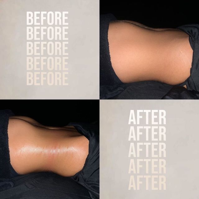 Before-and-after collage showing side view of a tanned abdomen — smoother, sleeker waist and glossy skin after a body treatment, photographed on dark linens.
