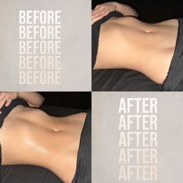 Before-and-after collage of a toned midsection showing a smoother, slimmer waist after body contouring treatment — side-by-side abdomen photos on a neutral background.