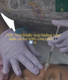 Close-up of gloved hands injecting under-eye tear-trough filler with a syringe in an aesthetic clinic, overlay text reads “POV: You finally stop hiding your dark circles with concealer.”