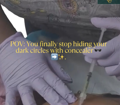 Close-up of gloved hands injecting under-eye tear-trough filler with a syringe in an aesthetic clinic, overlay text reads “POV: You finally stop hiding your dark circles with concealer.”
