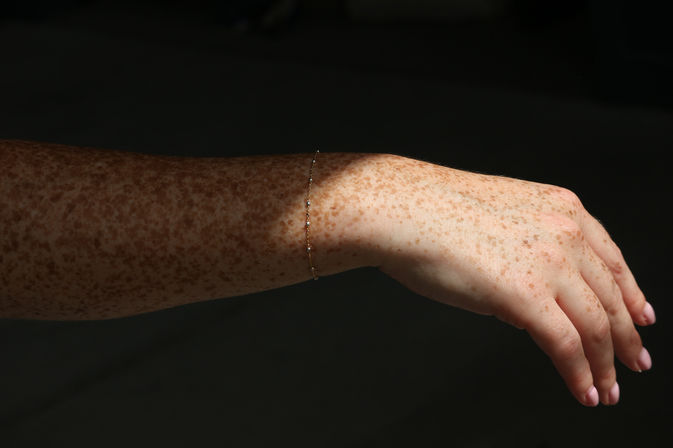 Sunlit freckled forearm and hand wearing a delicate gold chain bracelet, close-up against a dark background.