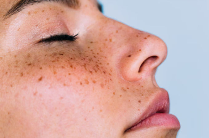 Close-up profile of a freckled face showing cheek, nose, closed eye and lips against a soft blue background.