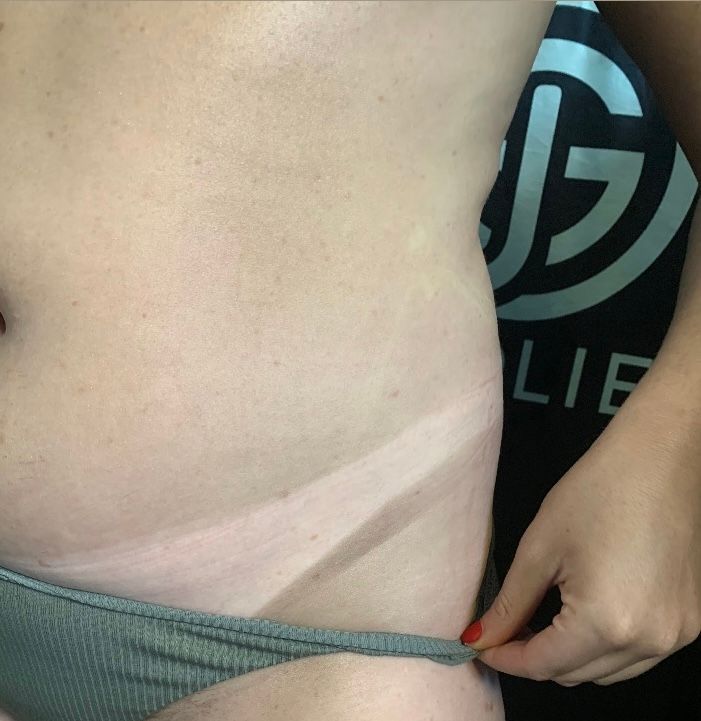 Close-up of a lower abdomen and hip showing a pale tan line, with a hand wearing red nail polish pulling down a green ribbed bikini bottom strap.