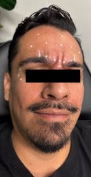 Close-up of a man reclining in an aesthetic clinic chair with white dot markings on his forehead and around the eyes for cosmetic injections (Botox), short mustache and goatee visible, eyes obscured for privacy.