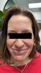 Close-up smiling woman's face with black bar over eyes, small white marker dots on forehead for cosmetic treatment planning, indoor clinical setting.