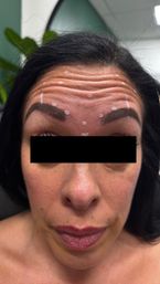 Close-up of a woman’s forehead with white marking dots and pronounced horizontal wrinkles, pre-cosmetic injection treatment in a clinic