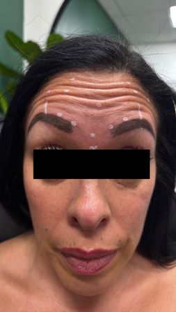 Close-up of a woman’s forehead with white marking dots and pronounced horizontal wrinkles, pre-cosmetic injection treatment in a clinic