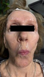 Close-up clinical photo of an older woman puckering lips to show vertical perioral wrinkles, with white pre-injection markings on forehead, temples and upper lip, headband and black bar over eyes indicating cosmetic treatment preparation.