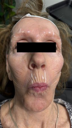 Close-up clinical photo of an older woman puckering lips to show vertical perioral wrinkles, with white pre-injection markings on forehead, temples and upper lip, headband and black bar over eyes indicating cosmetic treatment preparation.